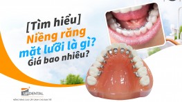 [Tìm hiểu] Niềng răng mặt lưỡi là gì? Giá bao nhiêu?
