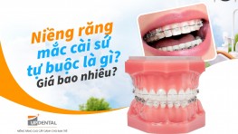 Niềng răng mắc cài sứ tự buộc là gì? Giá bao nhiêu?