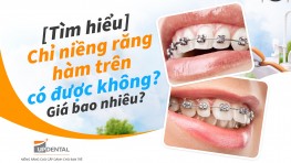 [Tìm hiểu] Chỉ niềng răng hàm trên có được không? Giá bao nhiêu?