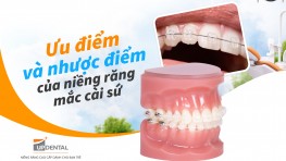 Ưu điểm và nhược điểm của niềng răng mắc cài sứ