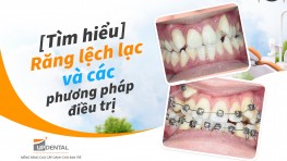 [Tìm hiểu] Răng lệch lạc và các phương pháp điều trị
