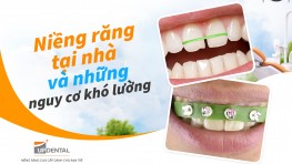 Niềng răng tại nhà và những nguy cơ khó lường
