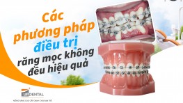 Các phương pháp điều trị răng mọc không đều hiệu quả