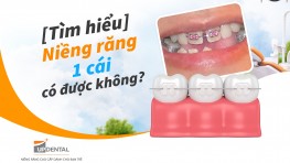 [Tìm hiểu] Niềng răng 1 cái có được không?