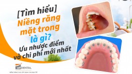 [Tìm hiểu] Niềng răng mặt trong là gì? Ưu nhược điểm và chi phí mới nhất