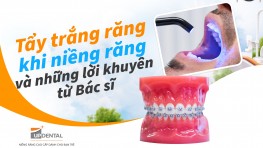 Tẩy trắng răng khi niềng răng và những lời khuyên từ Bác sĩ