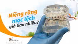 Niềng răng mọc lệch giá bao nhiêu? [2026]