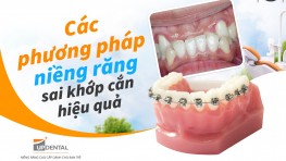 Các phương pháp niềng răng sai khớp cắn hiệu quả