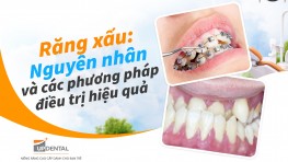 Răng xấu: Nguyên nhân và các phương pháp điều trị hiệu quả