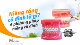 Niềng răng cố định là gì? 6 phương pháp niềng cố định
