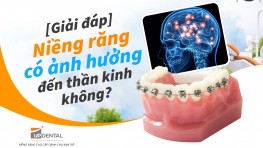 [Giải đáp] Niềng răng có ảnh hưởng đến thần kinh không?