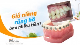 Giá niềng răng hô bao nhiêu tiền? [năm 2026]