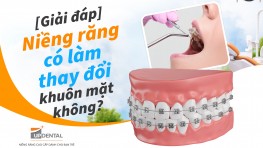 [Giải đáp] Niềng răng có làm thay đổi khuôn mặt không?