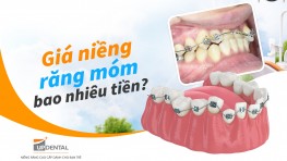 Giá niềng răng móm bao nhiêu tiền? [năm 2026]