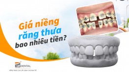 Giá niềng răng thưa bao nhiêu tiền? [năm 2026]