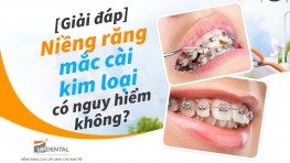 [Giải đáp] Niềng răng mắc cài kim loại có nguy hiểm không?