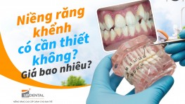 Niềng răng khểnh có cần thiết không? Giá bao nhiêu? [2026]
