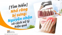 [Tìm hiểu] Nhổ răng bị sưng: Nguyên nhân và cách xử lý hiệu quả