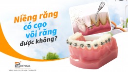 Niềng răng có cạo vôi răng được không?