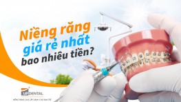 Niềng răng giá rẻ nhất bao nhiêu tiền?