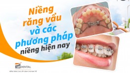 Niềng răng vẩu và các phương pháp niềng hiện nay