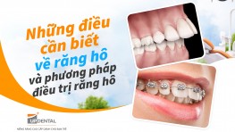 Những điều cần biết về răng hô và phương pháp điều trị răng hô