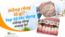 Niềng răng là gì? Top 10 tác dụng niềng răng mang lại