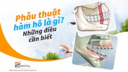 Phẫu thuật hàm hô là gì? Những điều cần biết