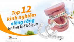 Top 12 kinh nghiệm niềng răng không thể bỏ qua