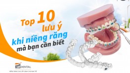 Top 10 lưu ý khi niềng răng mà bạn cần biết