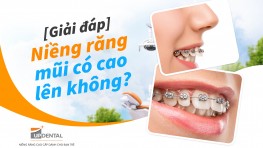 [Giải đáp] Niềng răng mũi có cao lên không? 