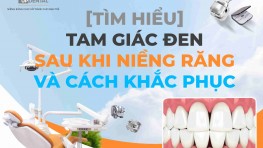 [Tìm hiểu] Tam giác đen sau khi niềng răng và cách khắc phục