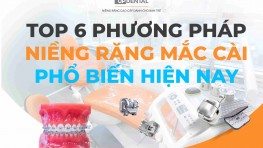Top 6 phương pháp niềng răng mắc cài phổ biến hiện nay