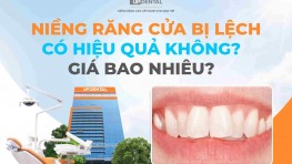 Niềng răng cửa bị lệch có hiệu quả không? Giá bao nhiêu?