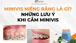 Minivis niềng răng là gì? Những lưu ý khi cắm minivis
