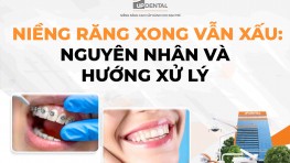 Niềng răng xong vẫn xấu: Nguyên nhân và hướng xử lý