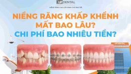 Niềng răng khấp khểnh mất bao lâu? Chi phí bao nhiêu tiền?