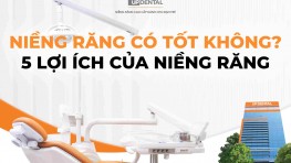 Niềng răng có tốt không? 5 lợi ích của niềng răng