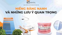 Niềng răng nanh và những lưu ý quan trọng