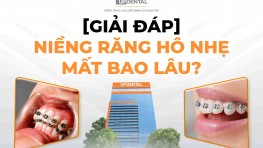 [Giải đáp] Niềng răng hô nhẹ mất bao lâu?