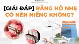 [Giải đáp] Răng hô nhẹ có nên niềng không?