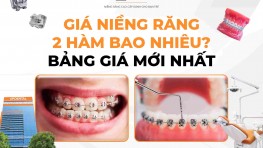 Giá niềng răng 2 hàm bao nhiêu? Bảng giá mới nhất 