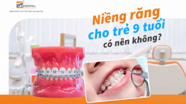 Niềng răng cho trẻ 9 tuổi có nên không?