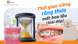 Thời gian niềng răng thưa mất bao lâu [Giải đáp]