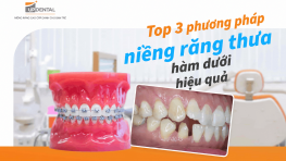 Top 3 phương pháp niềng răng thưa hàm dưới hiệu quả