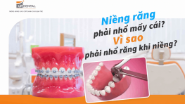 Niềng răng phải nhổ mấy cái? Vì sao phải nhổ răng khi niềng?