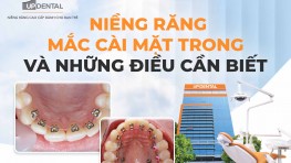 Niềng răng mắc cài mặt trong và những điều cần biết