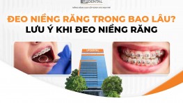 Đeo niềng răng trong bao lâu? Lưu ý khi đeo niềng răng