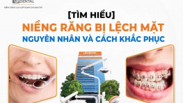 [Tìm hiểu] Niềng răng bị lệch mặt - Nguyên nhân và cách khắc phục