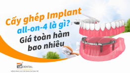 Cấy ghép Implant all-on-4 là gì? Giá toàn hàm bao nhiêu
